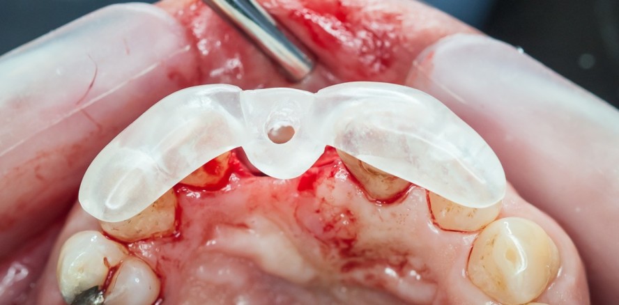 Abrechnung: Bohrschablone zur Implantation