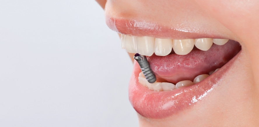 Abrechnung: Stabilitätsmessung an Implantaten