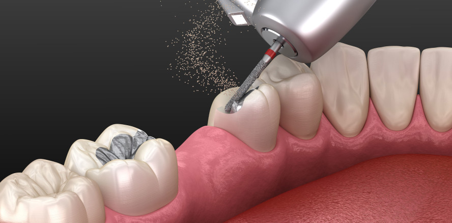 Noch wenige Schritte zum Amalgam-Ausstieg