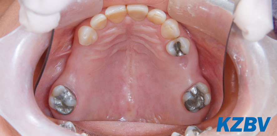 Amalgam: Alternativen für Kinder und Schwangere