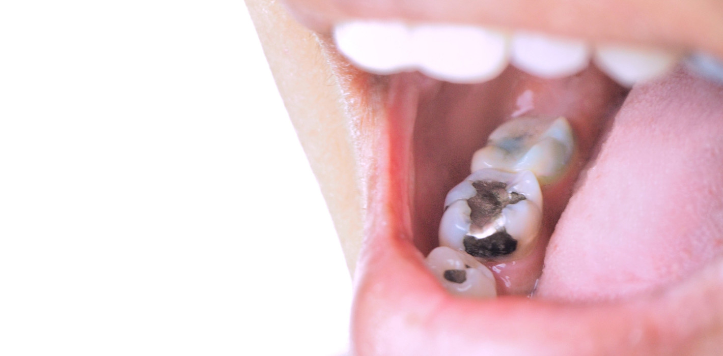 Kaum Fortschritte bei der Regulierung von Amalgam