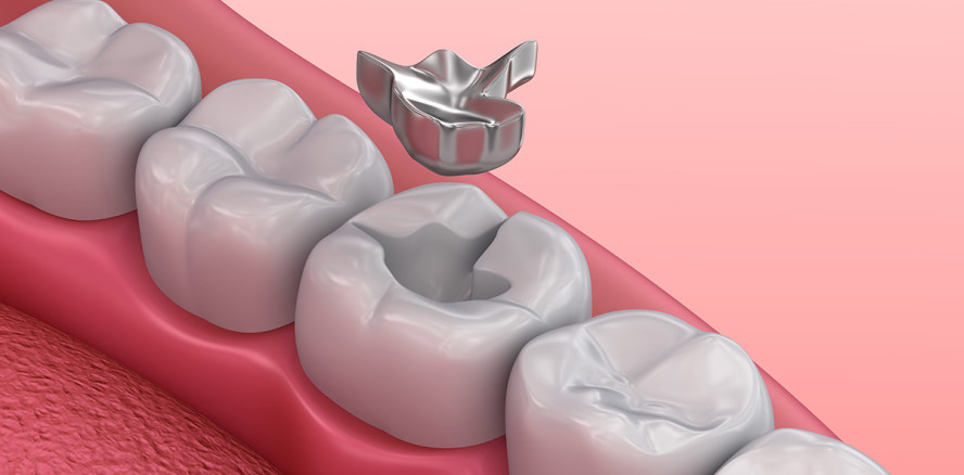 Kritik an Amalgam ist weder naturwissenschaftlich noch medizinisch begründbar