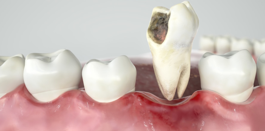 Karies ade? Forscher entwickeln antibakterielles Füllungsmaterial
