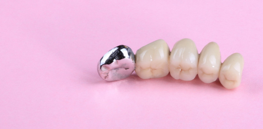 Anspruch auf Zahnersatz bei Vorschädigung durch Parodontitis