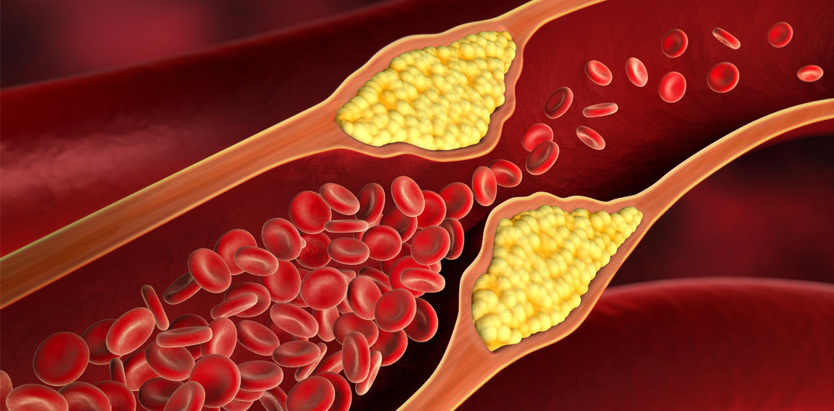 Bakterien im Mund: Ursache für Arteriosklerose?