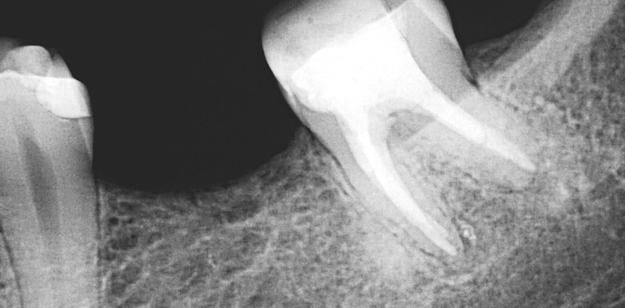 Revision eines Unterkiefermolaren mit lang anhaltender Schmerzanamnese