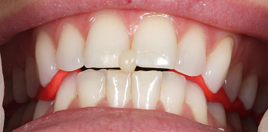 Behandlung einer Funktionsstörung mittels Bisslageveränderung