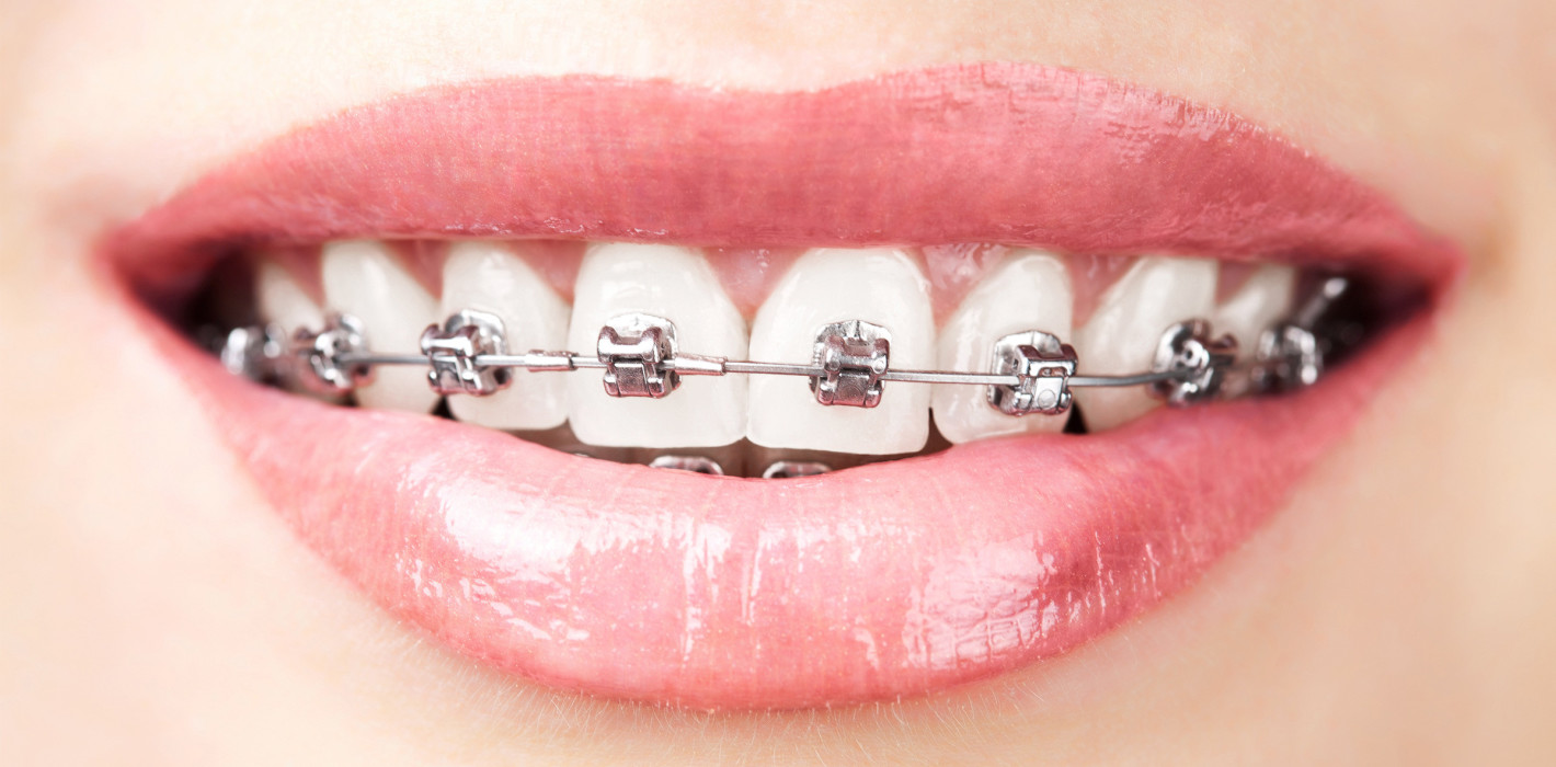 Brackets: Neuer Kleber soll vor Karies schützen