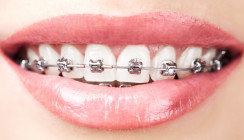 Brackets: Neuer Kleber soll vor Karies schützen