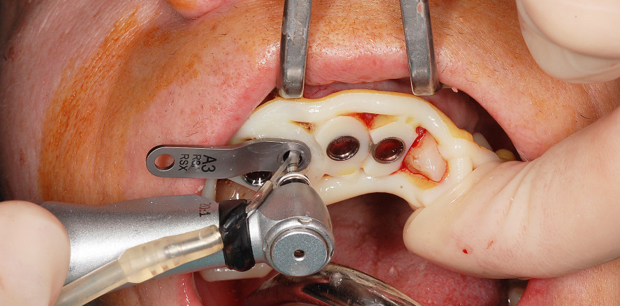 Digitale Technologie für ästhetische Restauration