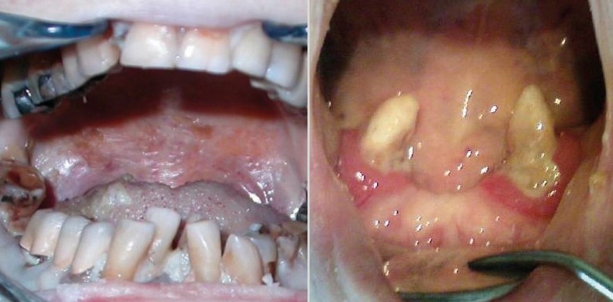 Zahnbehandlung bei dementen Menschen
