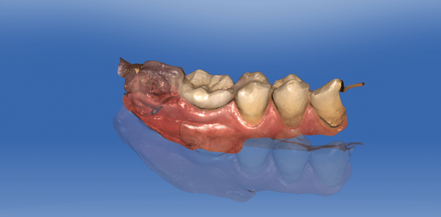 Am Zahn der Zeit: Digitale dentale Diagnostik mit Intraoralscannern