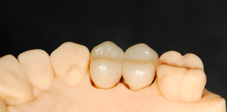 Kronen aus dem 3D-Drucker: Zukunft oder Realität?