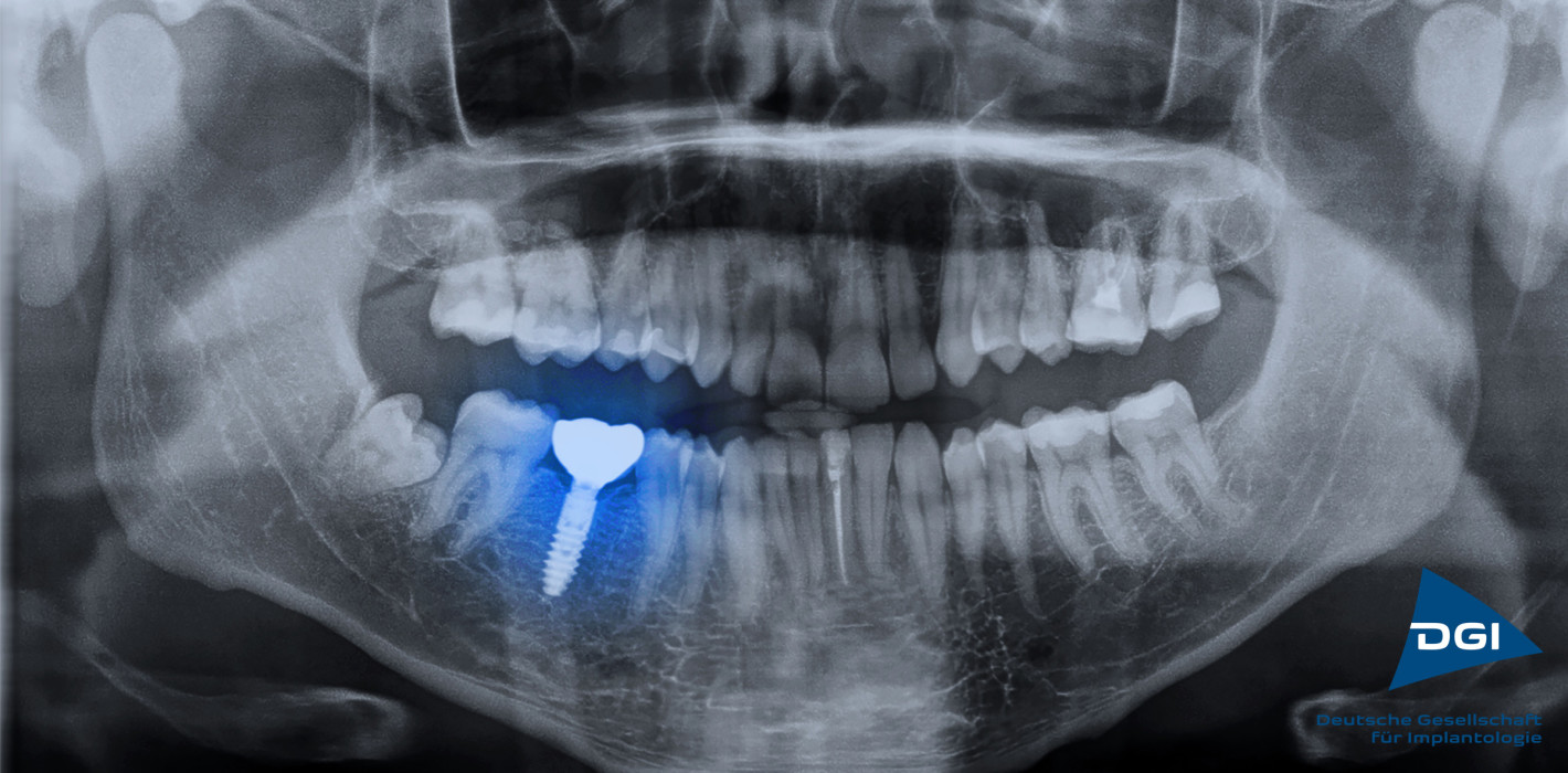 In Deutschland werden jährlich 1,3 Millionen Implantate gesetzt