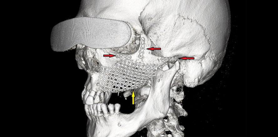 Navigierte OP unerlässlich: Bösartiger Tumor im Mittelgesicht