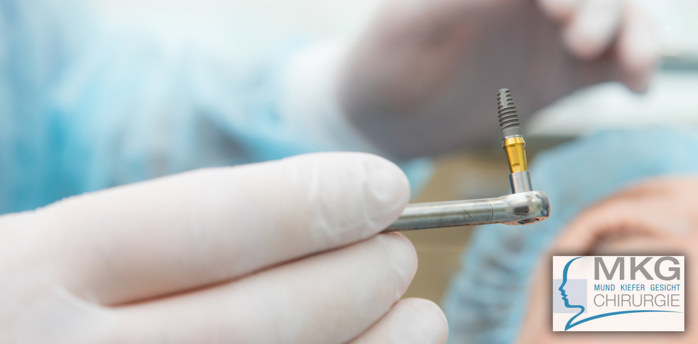 Patientenspezifische Implantate in der MKG-Chirurgie
