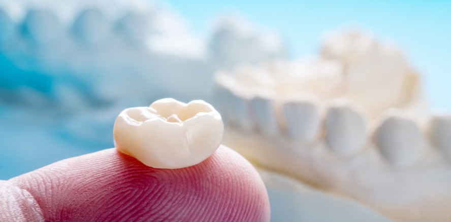 Leitlinie „Vollkeramische Kronen und Brücken“ ab sofort online