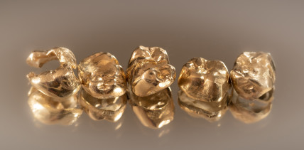 Betrüger in Oberbayern wollen Zahngold-Spenden abholen