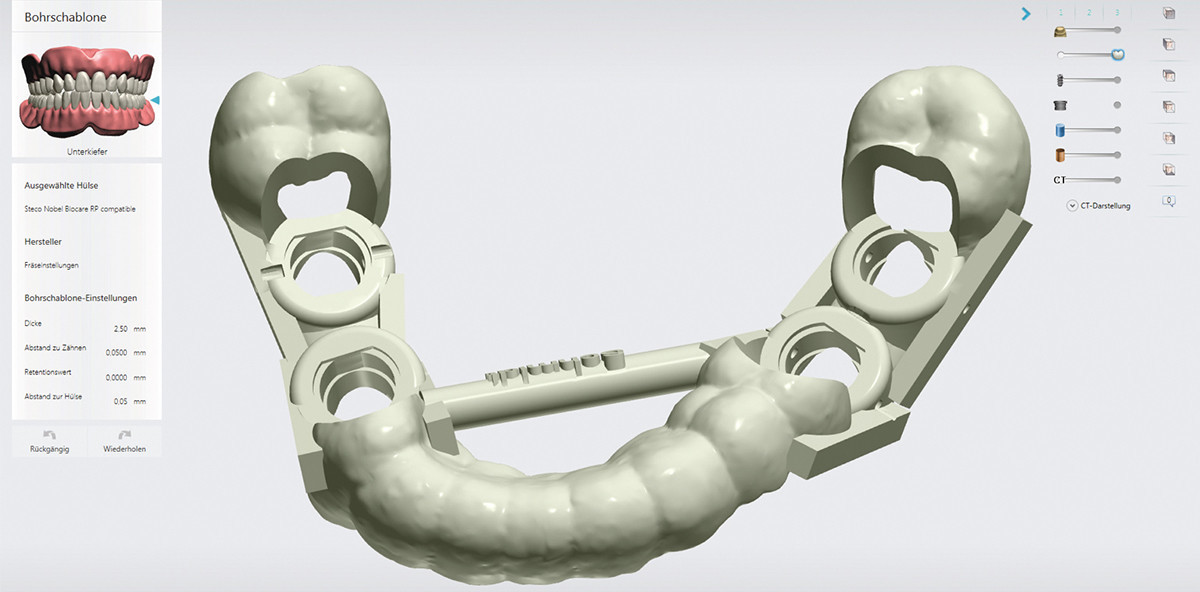 Digitale Implantologie: Zusammenführen von 3-D-Implantatplanung und 3-D-Druck