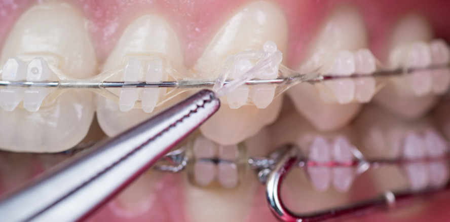 Debatte entfacht: Was bringen Zahnspangen und Co.?