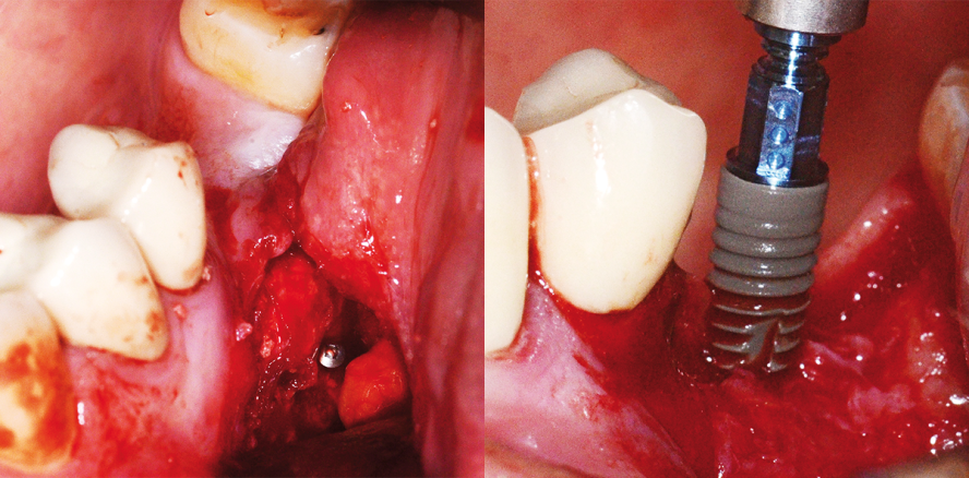 Komplexe Knochenaugmentation und Alternativen