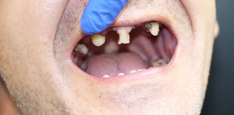 (Il)legale Drogen – Kryptonit für Zähne und Zahnfleisch