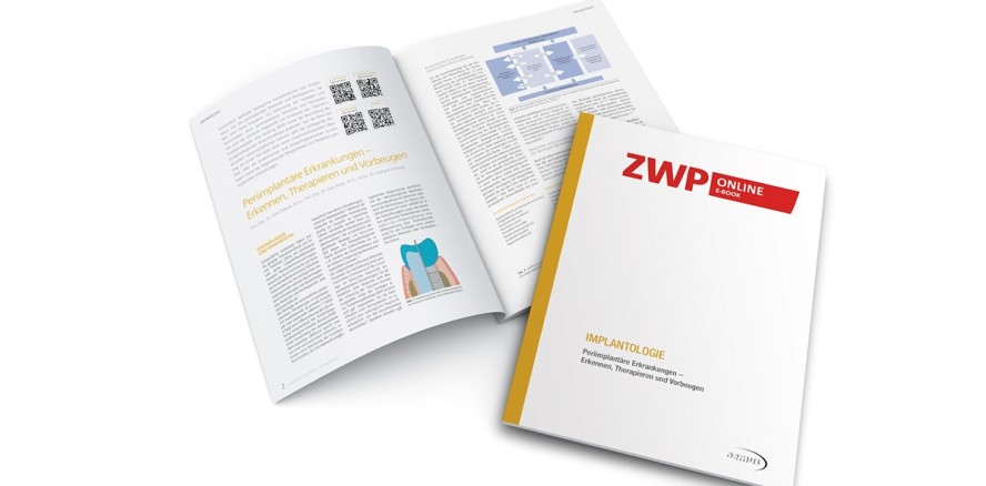 Neues eBook: Periimplantitis mit Konzept entgegentreten