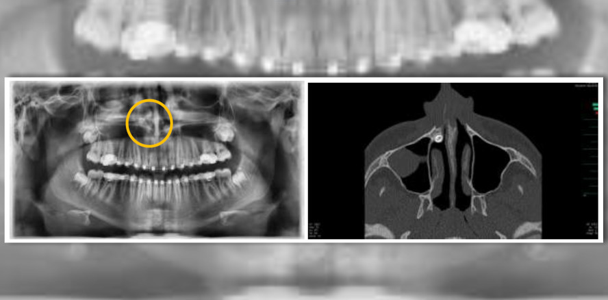 Außergewöhnlicher Fall: Chirurgen entfernen Zahn über die Nase