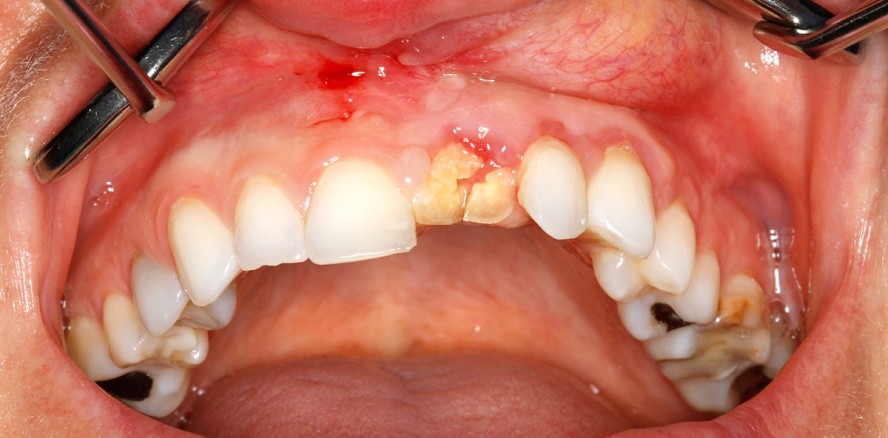 Sofortimplantation nach fazialem Pferdetritt