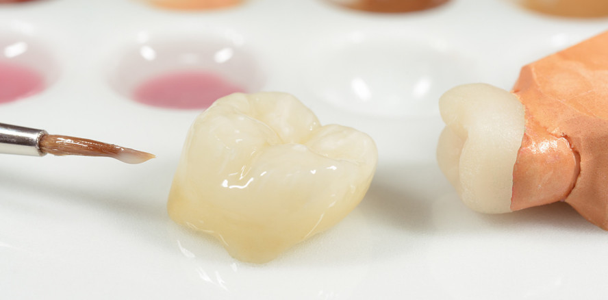 Grob fehlerhafte Kronenversorgung: Zahnarzt muss 4.500 Euro zahlen