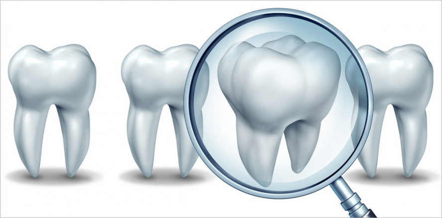 Update der S3-Leitlinie „Fissuren- und Grübchenversiegelung“