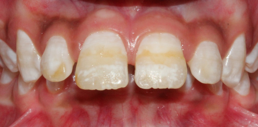 Fluorid in der Kritik: Verantwortlich für Zahnschmelzdefekte?