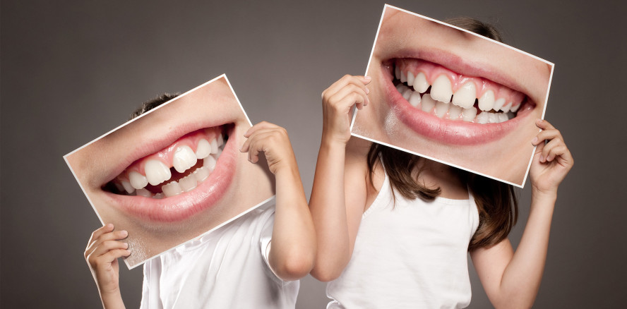 Fluoridlack im Milchgebiss kann Karies verhindern