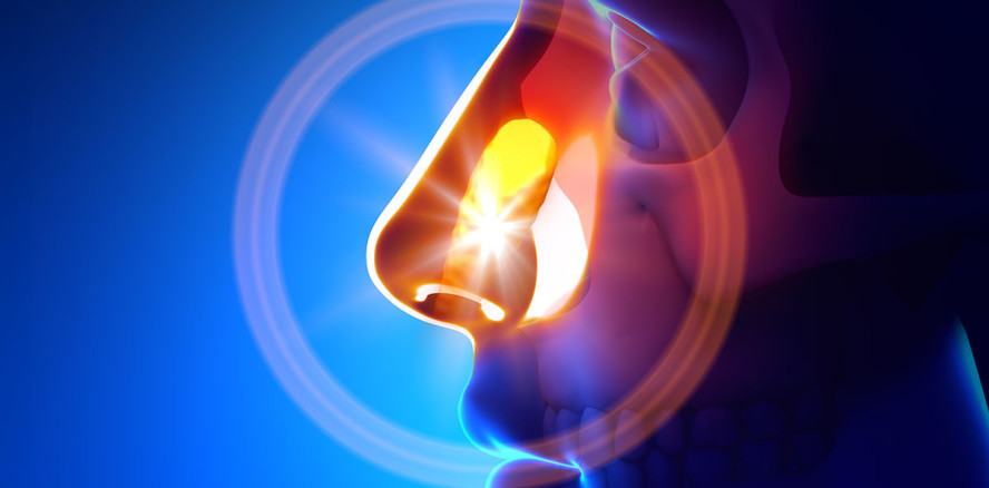 Permanentes Nasenbluten: Rhinitis stellt sich als eingewachsener Zahn heraus