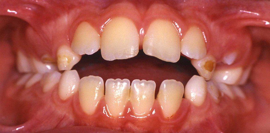 Der frontoffene Biss: Diagnose, Differenzialdiagnose und Prognose