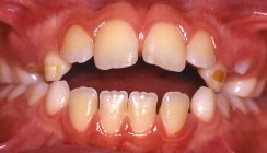 Der frontoffene Biss: Diagnose, Differenzialdiagnose und Prognose