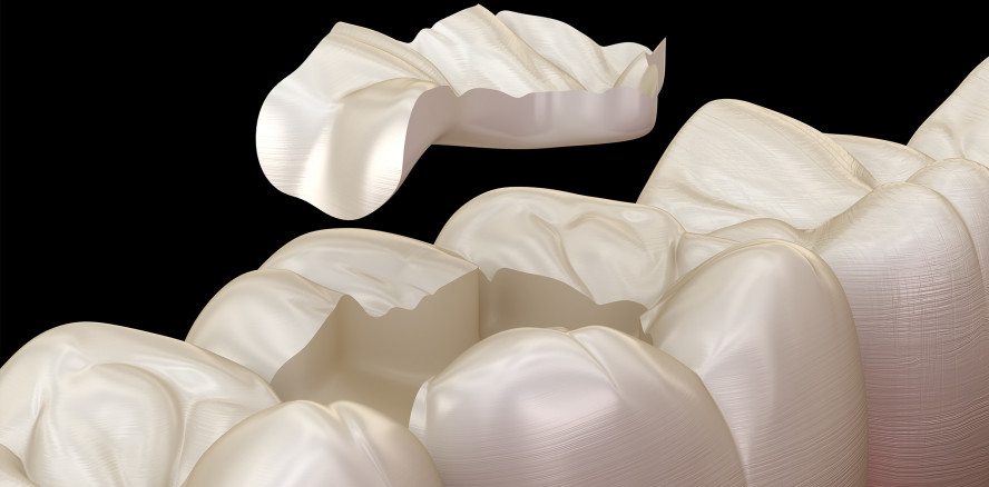 Erste Langzeitstudie zu Composite-Restaurationen