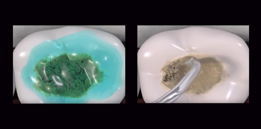 Bohren ade: Gel zur Kariesbehandlung entwickelt