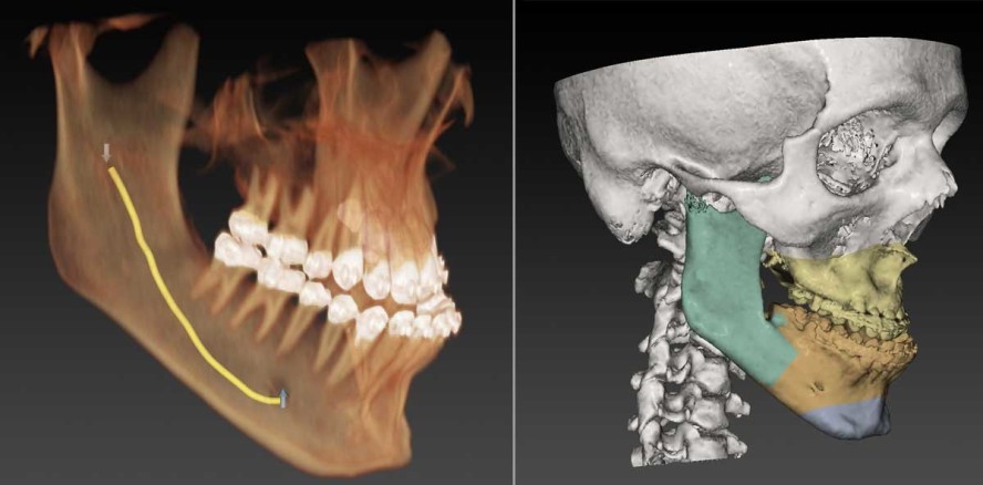 Virtuelle Planung von Gesichts-OPs immer beliebter