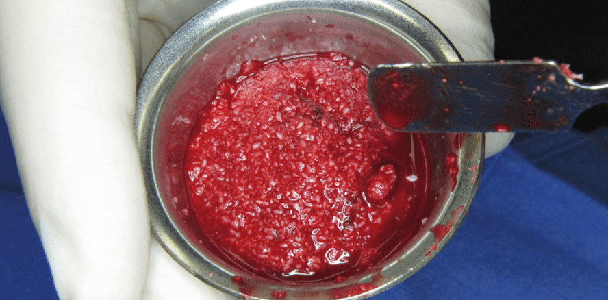 Externer Sinuslift mittels allogenem Kortikalisgranulat