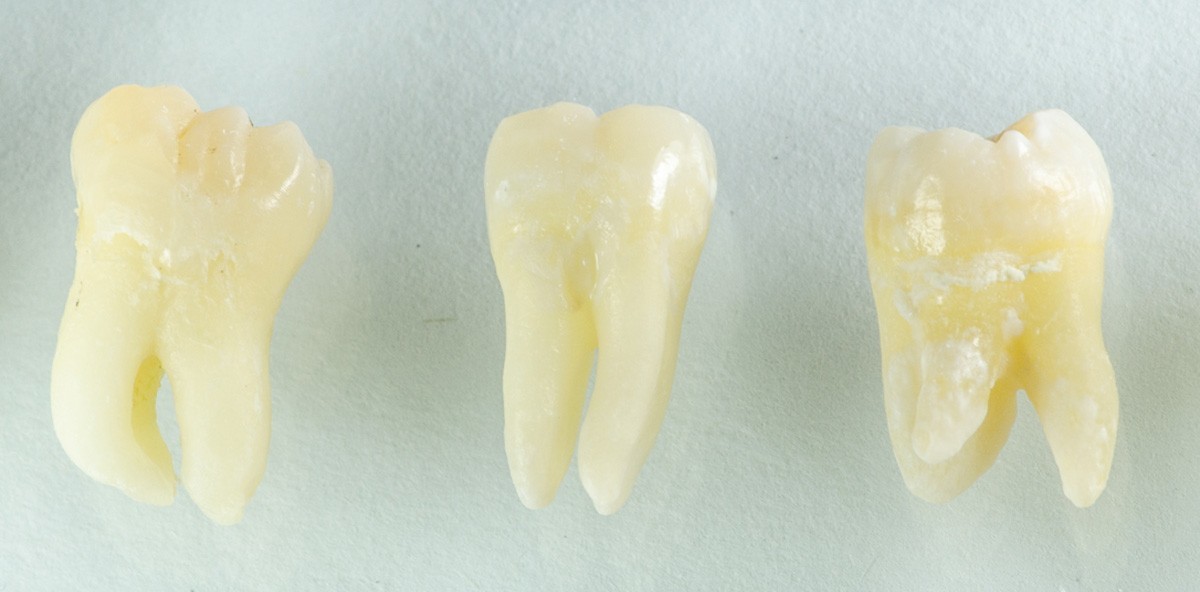 FOXI3-Gen beeinflusst die Höckerbildung der Backenzähne