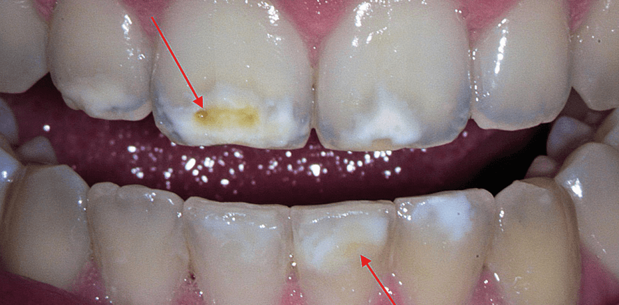 Diagnostik und therapeutische ­Konsequenzen der Molaren-Inzisiven-­Hypomineralisation – Teil 2
