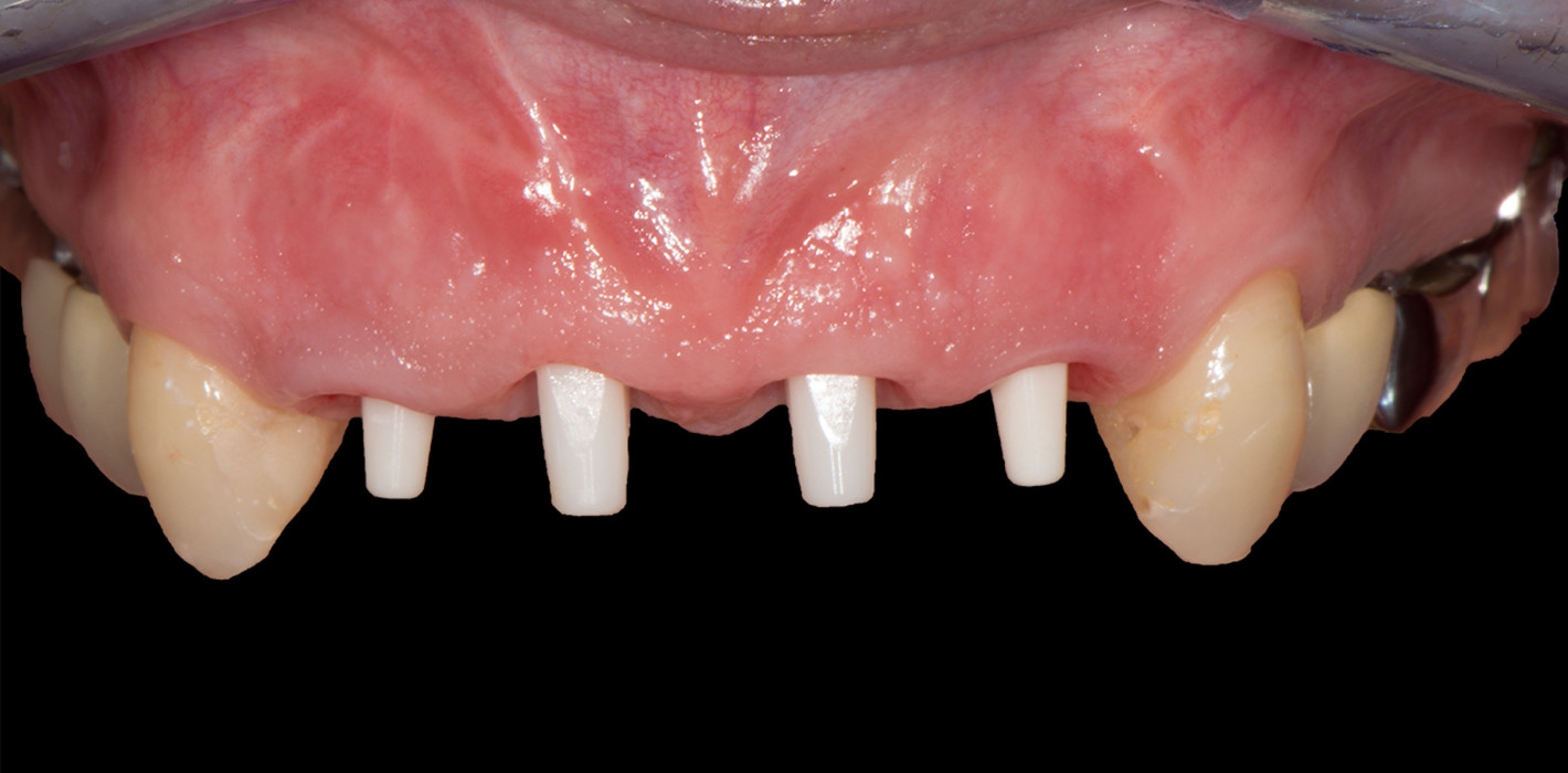 Biologische Vorteile bioinerter Keramikimplantate
