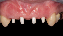 Biologische Vorteile bioinerter Keramikimplantate
