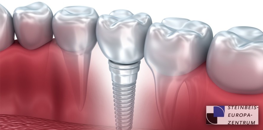 Implantateinsatz ohne Nebenwirkungen
