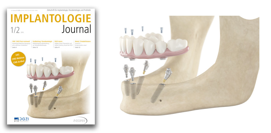 Implantologie Journal: Die erste Ausgabe des Jahres online lesen