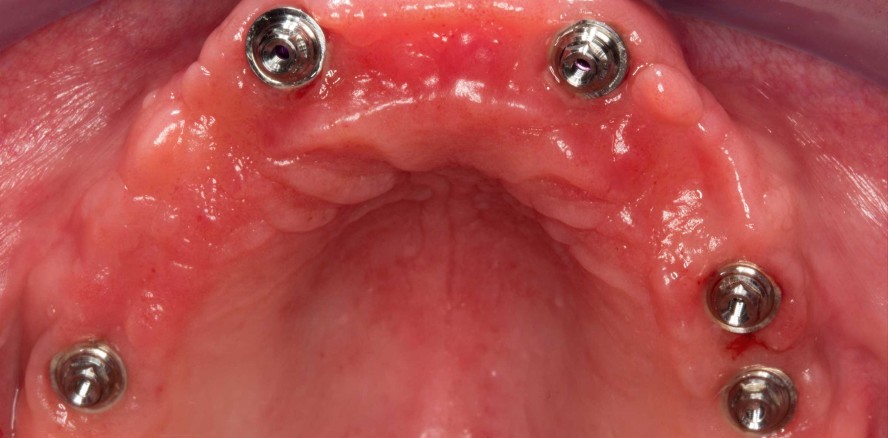 Digital gefertigte implantatgestützte Brückenversorgung