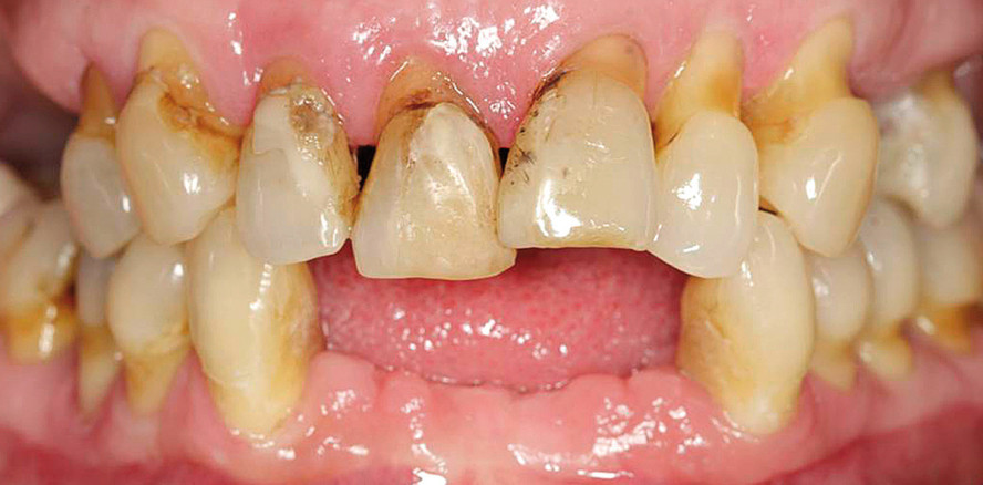 Zahnimplantate – Von der Planung im Team zum ästhetischen Gesamterfolg