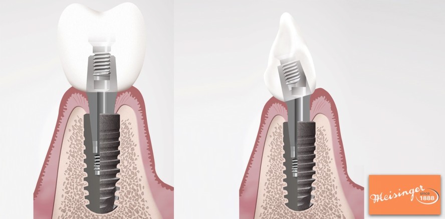 Erfolgreiches Implantatkonzept neu ausgerichtet
