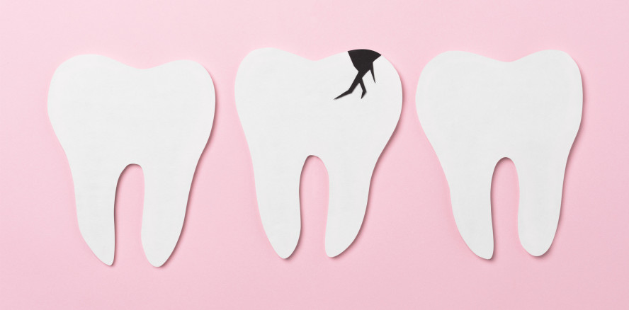 Kariesforschung: S. mutans nicht alleiniger Übeltäter